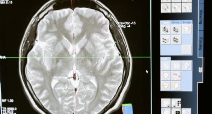 Identifican gen responsable de una nueva enfermedad neurológica