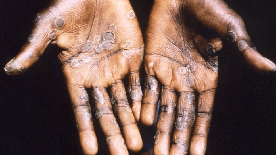 Imagen de las lesiones en la piel provocadas por la viruela del mono, durante un estudio llevado a cabo en la República Democrática del Congo entre los años 1996 y 1997. Foto: EFE / Brian W.j. Mahy / Center for Disease Control and Prevention