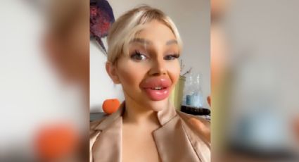 Influencer con labios 'gigantes' revela que ya no puede comer bien