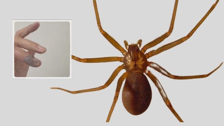 Joven es picado por una araña violinista; IMSS le niega atención médica en Puebla