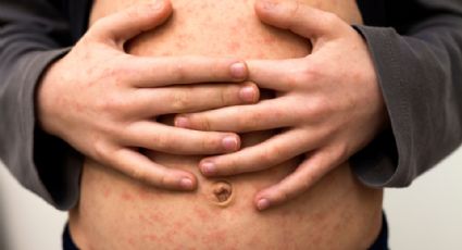 Sarampión: ¿Qué es y cuáles son los síntomas de esta contagiosa enfermedad?