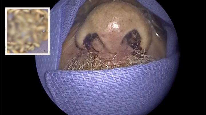 Hombre en Florida tenía 150 larvas alojadas en su nariz y no lo sabía