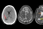 Hombre acude al médico por migraña y descubre que tenía larvas en el cerebro en EU