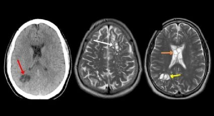 Hombre acude al médico por migraña y descubre que tenía larvas en el cerebro en EU