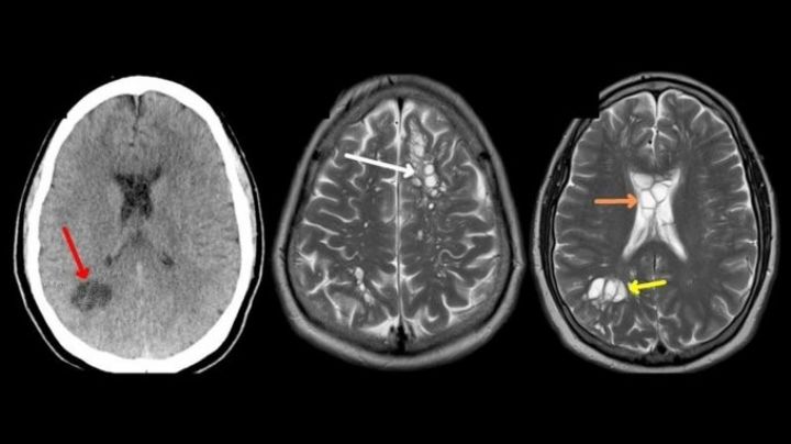 Hombre acude al médico por migraña y descubre que tenía larvas en el cerebro en EU