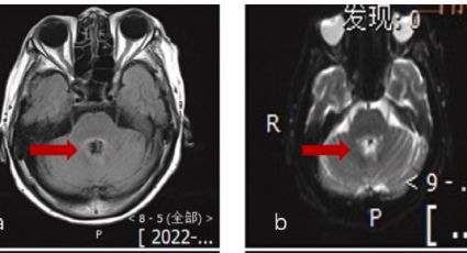 Diagnostican a abuelita con cáncer cerebral; en realidad una ameba la devoraba en China