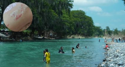 Bañistas regresan del río Ramos con extraña alergia; ¿de qué se trata?