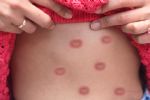 Mpox: ¿Cómo se contagia la viruela del mono?
