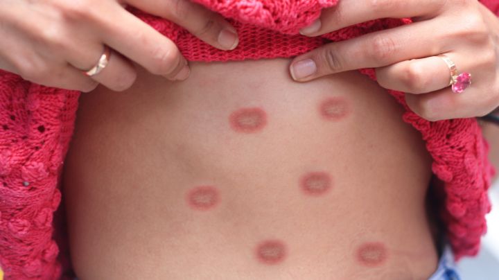 Mpox: ¿Cómo se contagia la viruela del mono?
