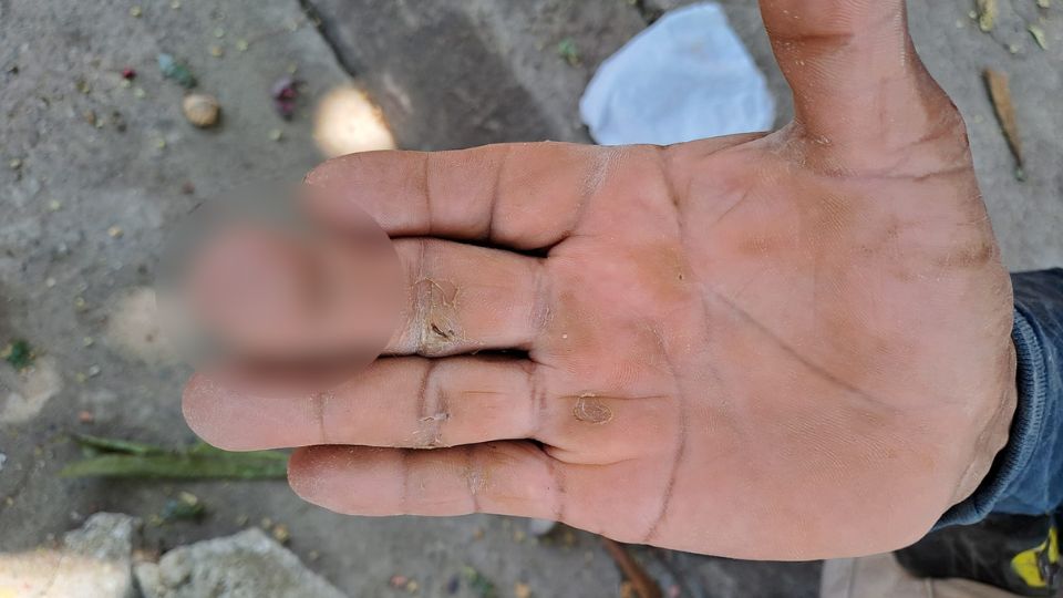 Albañil muestra su mano sin el uso de guantes