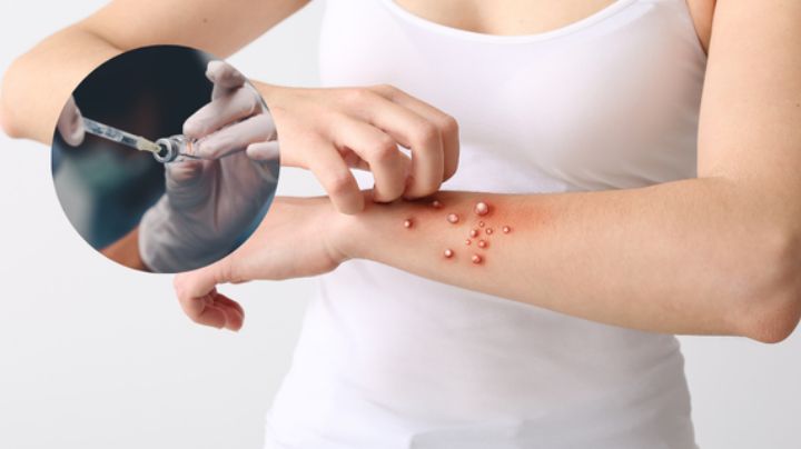 Cofepris autoriza registro de vacuna contra mpox, viruela del mono, ¿quienes podrán aplicársela?