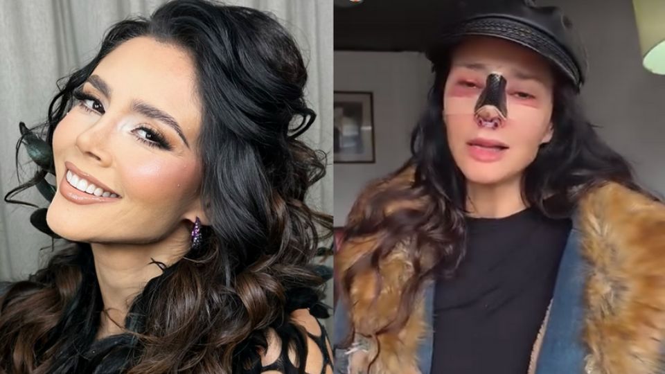 Dorismar sufrió graves daños en su nariz tras un mal procedimiento estético