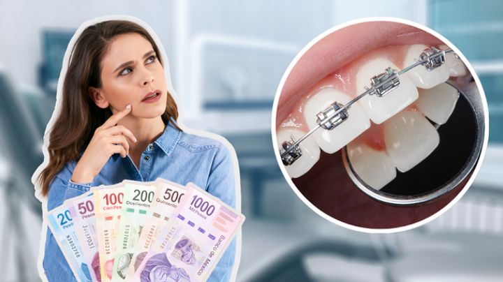 ¿Cuánto dinero necesito ahorrar para ponerme brackets? Ideas de presupuesto