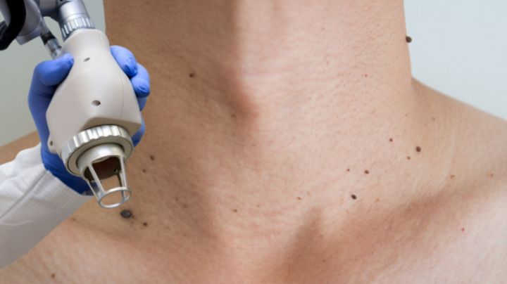 Así puedes eliminar las pequeñas verrugas que salen en el cuello ¿Cuánto cuesta el tratamiento láser