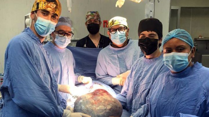 Médicos del IMSS extirpan un tumor de 21 kilos del ovario de una mujer, Guanajuato