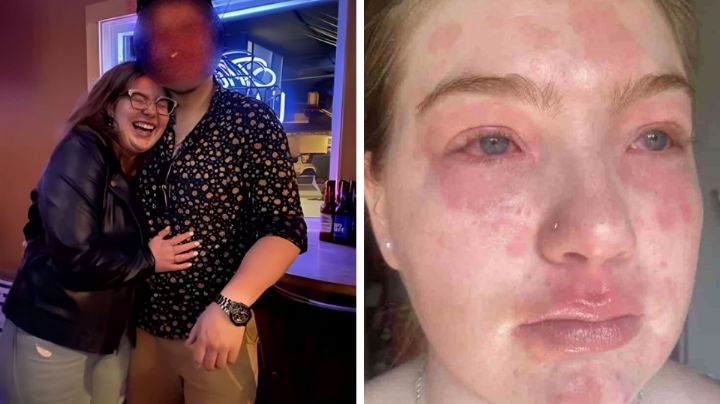 Mujer cree que es alérgica a su novio tras sufrir sarpullido cada vez que lo ve