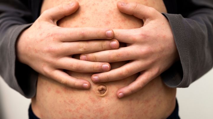 Sarampión: ¿Qué es y cuáles son los síntomas de esta contagiosa enfermedad?