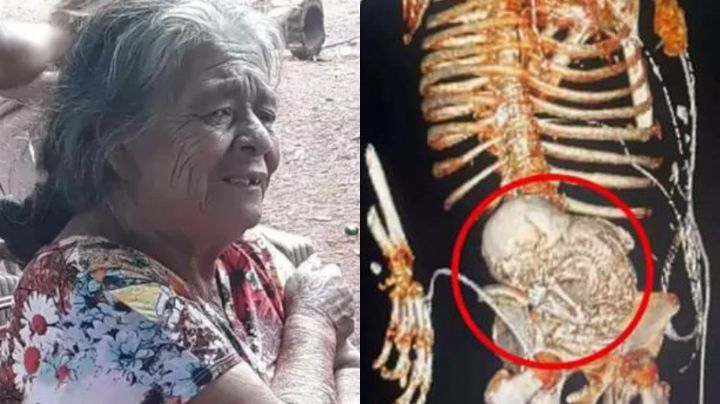 Abuelita brasileña va al doctor y le descubren feto ‘momificado’; la operan y muere