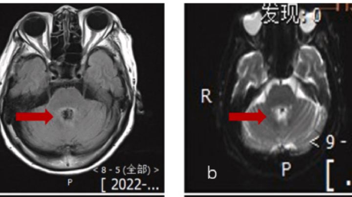 Diagnostican a abuelita con cáncer cerebral; en realidad una ameba la devoraba en China