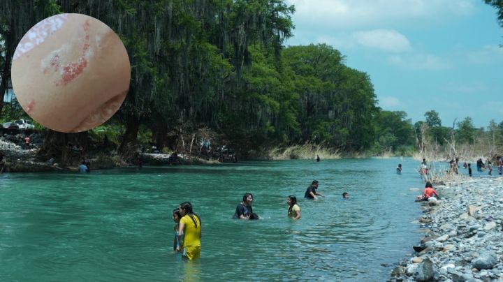Bañistas regresan del río Ramos con extraña alergia; ¿de qué se trata?