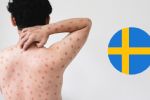 Brote de viruela del mono cruza fronteras e infecta a persona en Suecia
