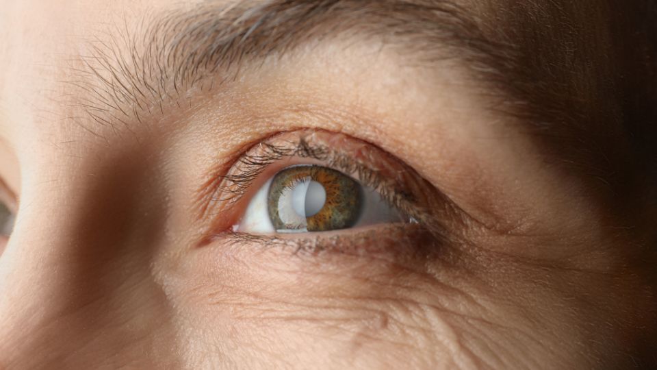 Persona con catarata en su ojo izquierdo