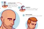 ¿Cuánto cuesta un injerto de cabello en México?