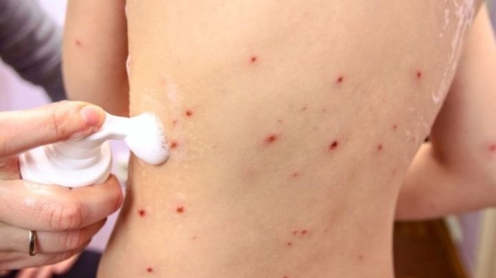 Secretaría de Salud alerta por brote de sarampión en Texas