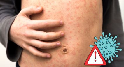 Secretaría de Salud lanza alerta epidemiológica por casos de sarampión