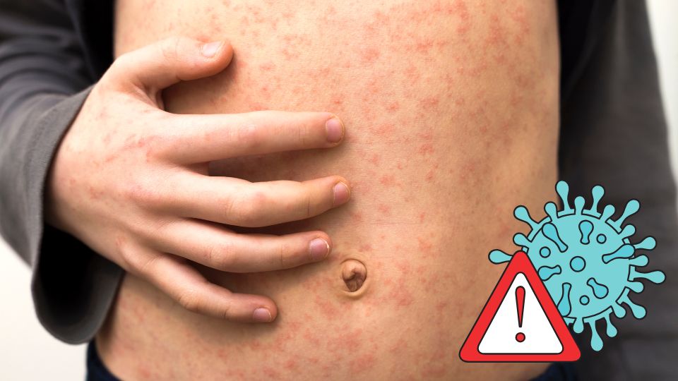 Crecen casos de sarampión; hay alerta epidemiológica