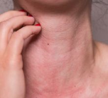 ¿Cómo saber si tengo alergia al sol y de qué forma se puede tratar?
