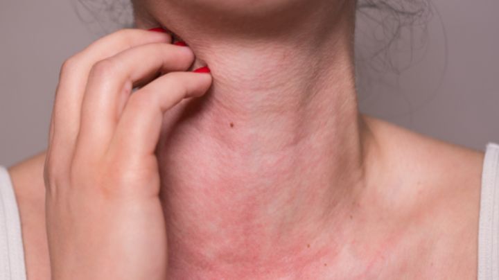¿Cómo saber si tengo alergia al sol y de qué forma se puede tratar?