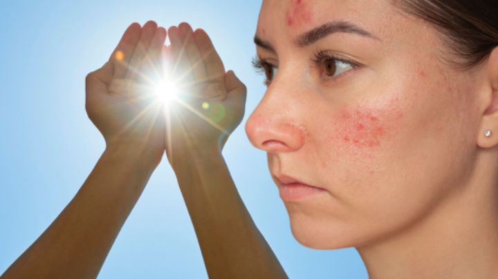 ¿Te pones muy rojo con el estrés o el sol? Podría ser señal de esta enfermedad