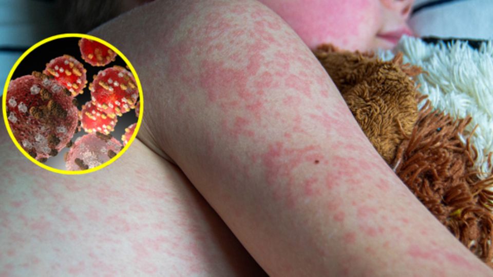 Virus del sarampión.