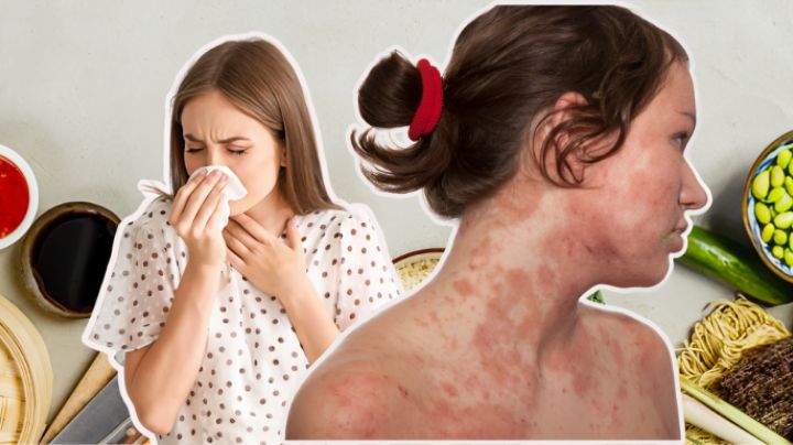 Día Mundial de la Alergia: alimentos que pueden causar reacciones sin que lo sepas