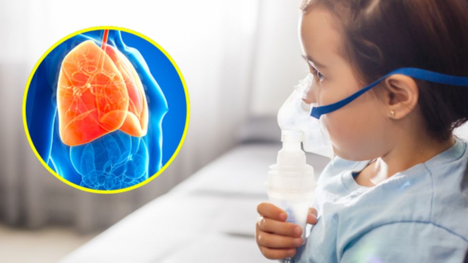 La fibrosis quística es causada por un gen defectuoso que provoca acumulación de moco espeso en pulmones, sistema digestivo y otros órganos.
