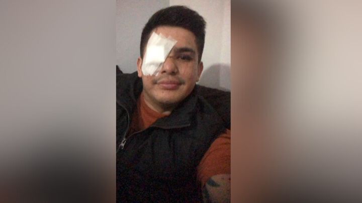 Piden apoyo para hombre afectado de su vista por explosión ocurrida en Pesquería