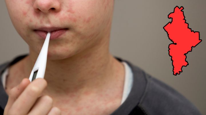 Brote de Sarampión: Confirman tercer caso en Nuevo León