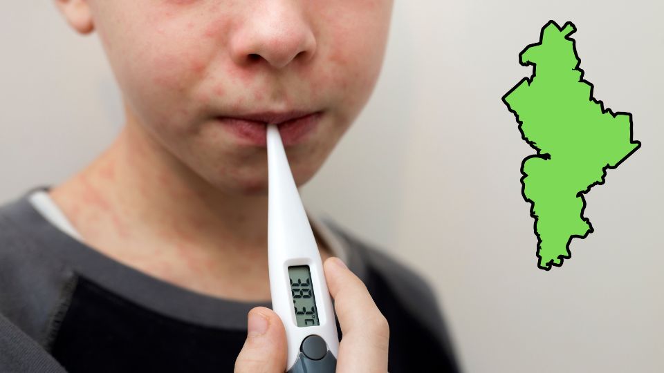 Menor de edad enfermo de sarampión