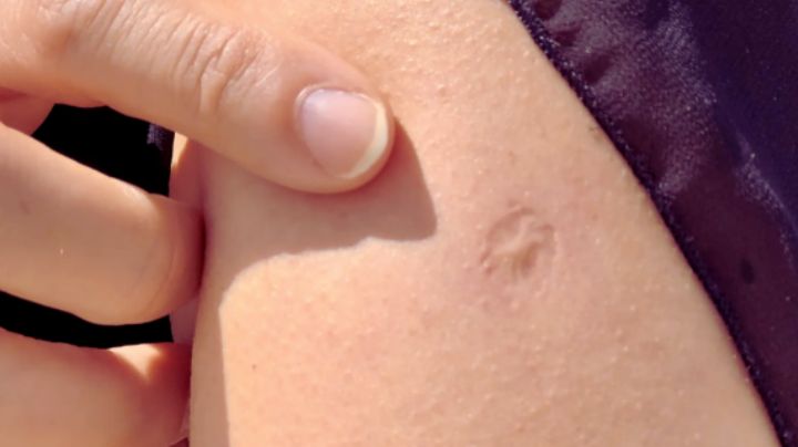 ¿Tienes la "marquita" en el hombro? Sheinbaum aclara que no es por el sarampión