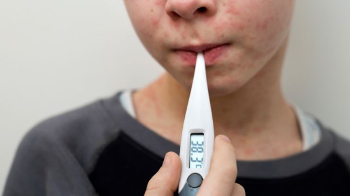 Casos de sarampión en Nuevo León aumentan a 39