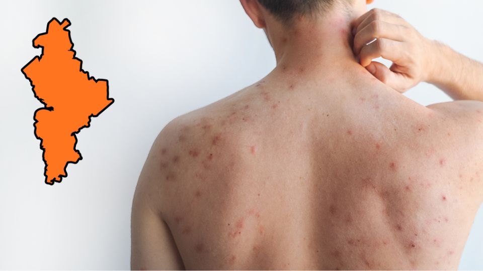 Persona contagiada de sarampión