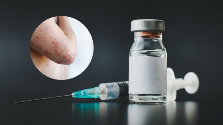 Casos de sarampión en Nuevo León: qué vacuna debes ponerte y por qué