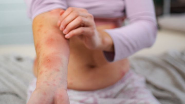 Aumentan a 23 los casos de sarampión en Nuevo León