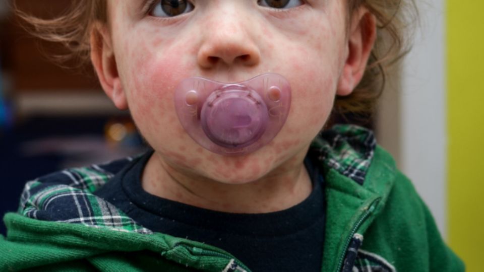 El sarampión se caracteriza por la aparición de erupciones en la piel.