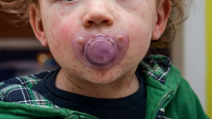 Muere menor de 2 años en Guerrero, por presunto caso de sarampión