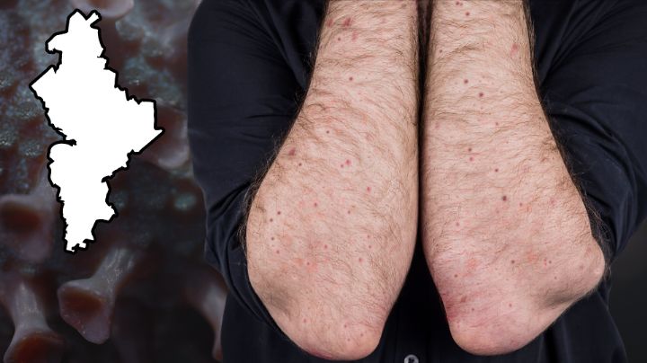 Sarampión en NL: Estos son los municipios con más contagios