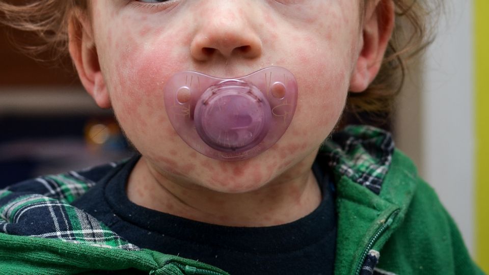 El menor falleció durante por presunto contagio de Sarampión.