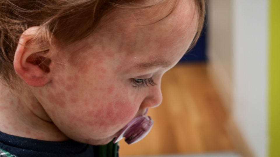 El sarampión provoca la aparición de exantema en la piel.