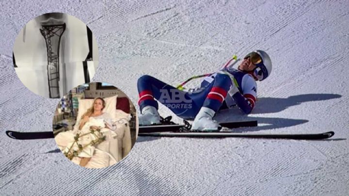 Lindsey Vonn estuvo cerca de amputación tras caída en Juegos Olímpicos 2026